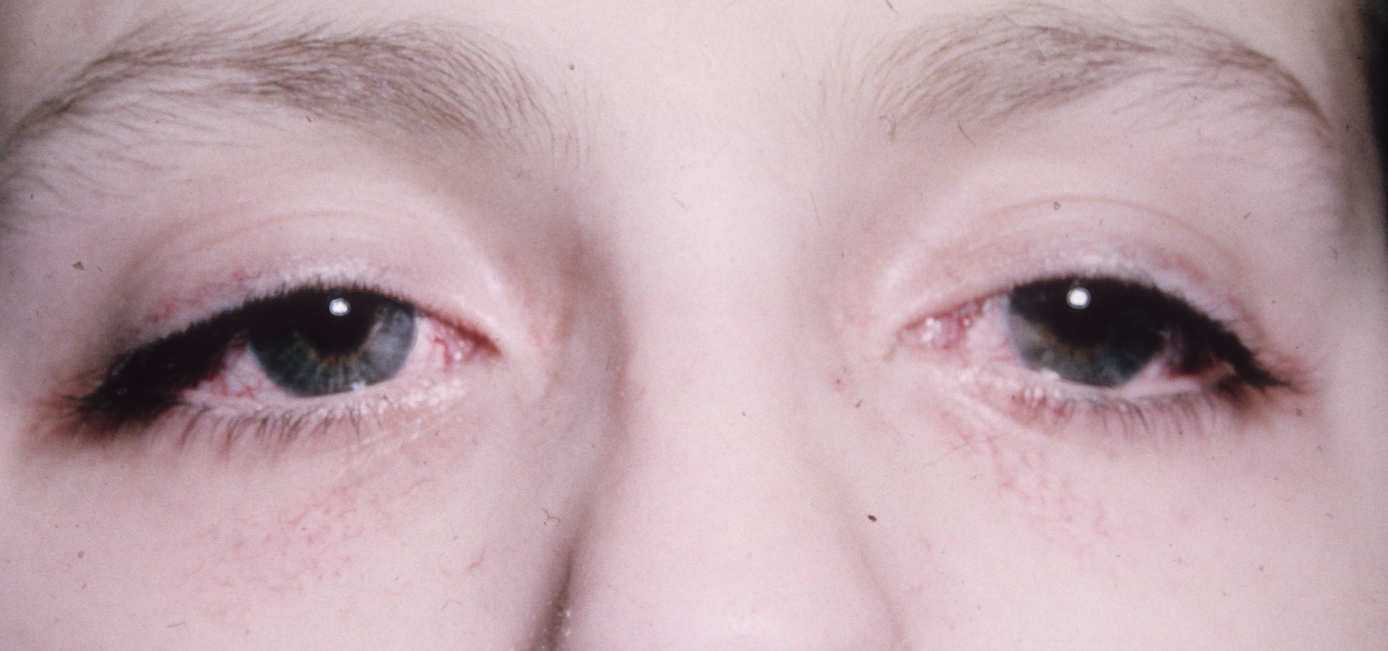 Ataxia-Telangiectasia | Hereditary Ocular Diseases